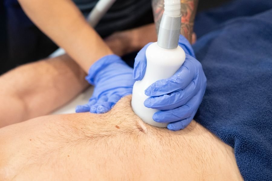 a close up of a cryoskin procedure.